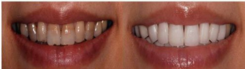 牙齿美白前后对比图
