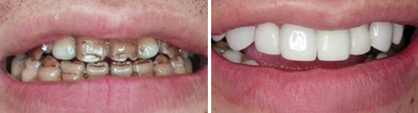 牙齿贴面前后对比图