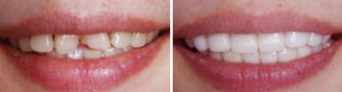 牙齿美容前后对比图
