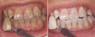 牙齿美白前后对比图