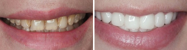 牙齿修复前后对比图