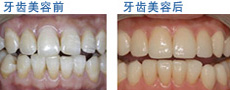牙齿美容前后对比图