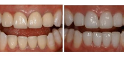 牙齿美容前后对比图