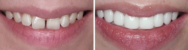 牙齿美容前后对比图
