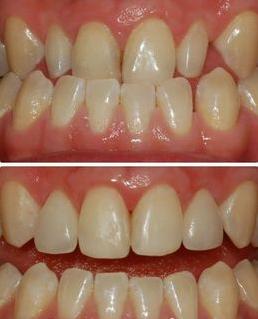 牙齿拥挤是怎么回事 牙齿拥挤是怎么回事