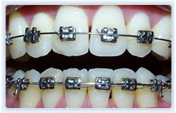 成人牙齿矫正一般需要多少钱 成人牙齿矫正一般需要多少钱