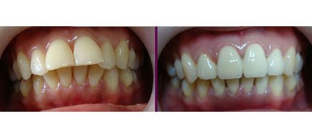 郑州哪家医院牙齿矫正好 郑州哪家医院牙齿矫正好