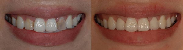 牙齿做美容冠好吗 牙齿做美容冠好吗