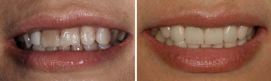 烤瓷牙的价格及种类 烤瓷牙的价格及种类