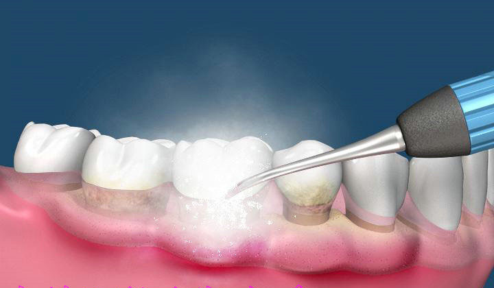 洗牙到底疼不疼啊 洗牙到底疼不疼啊