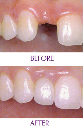 门牙掉了补一颗多少钱 门牙掉了补一颗多少钱