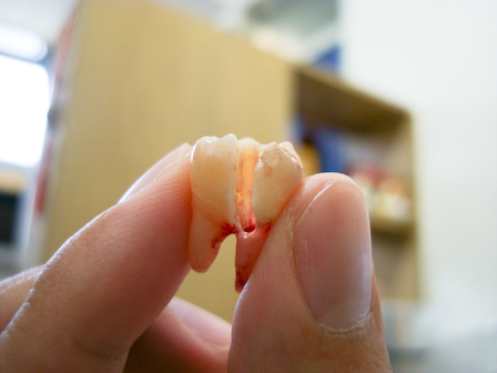 智齿疼的时候能拔吗 智齿疼的时候能拔吗