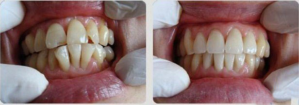 我现在22岁矫正牙齿晚吗 我现在22岁矫正牙齿晚吗