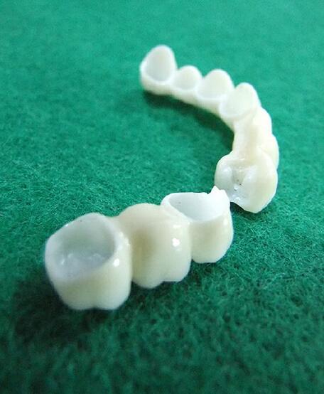 普通烤瓷牙多少钱一颗 普通烤瓷牙多少钱一颗