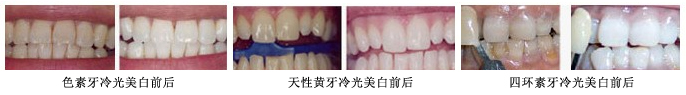 冷光美白案例